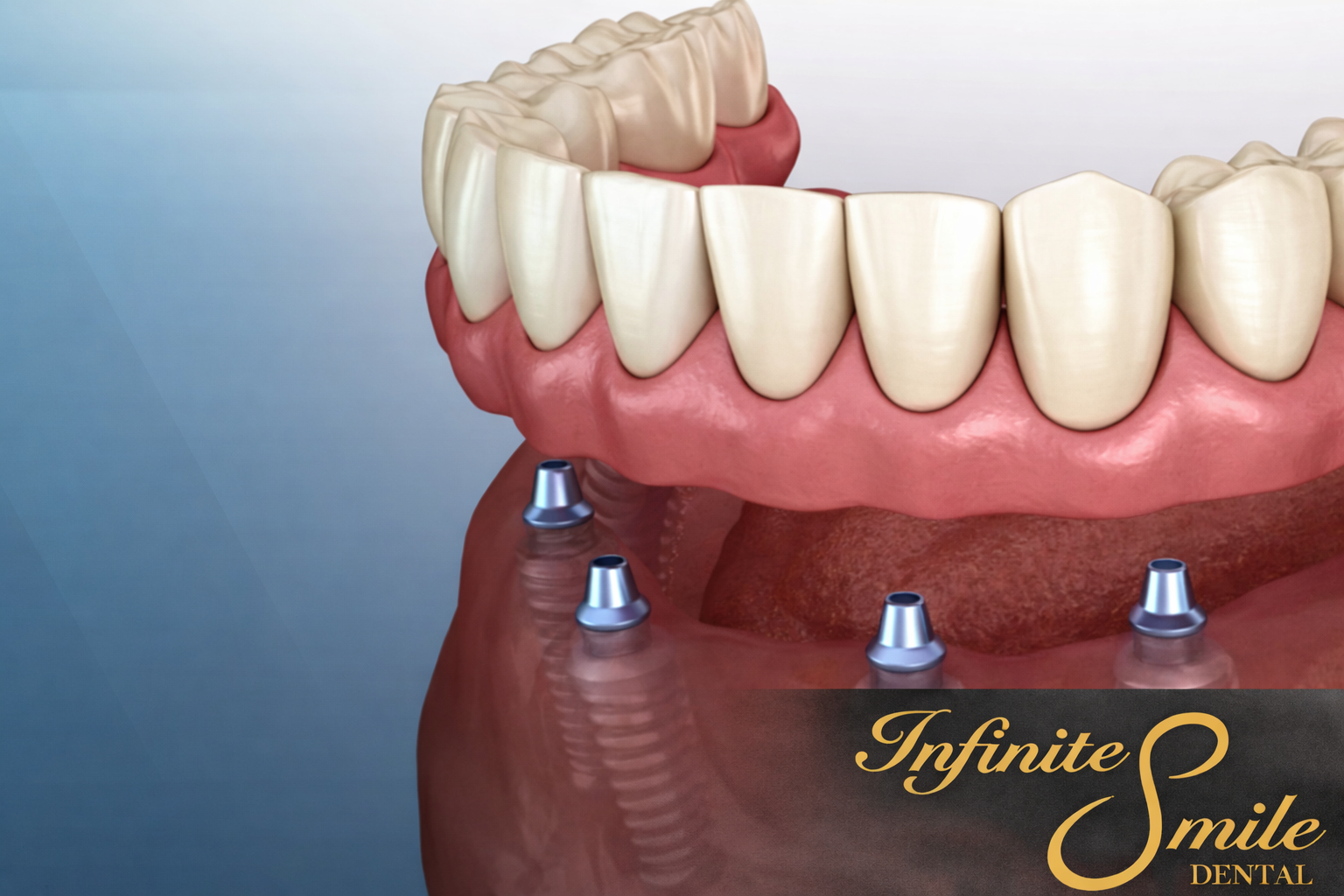 Implant-Supported Dentures in Pleasanton, CA