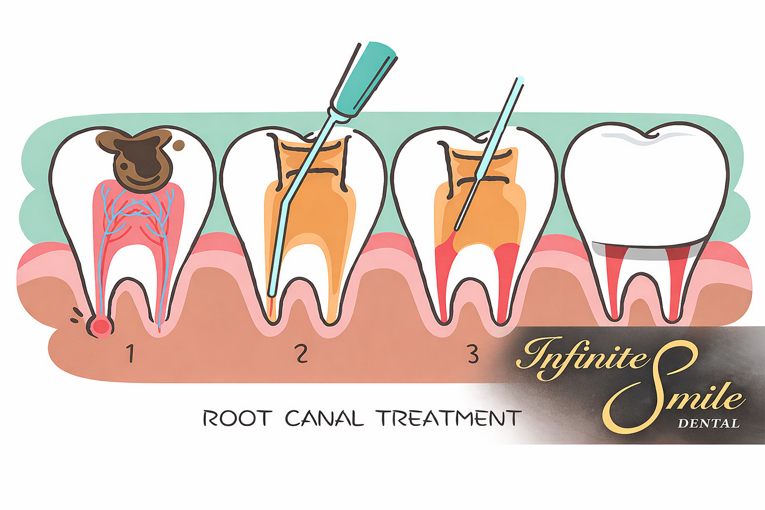 Everything You Need to Know About Root Canals in Pleasanton, CA