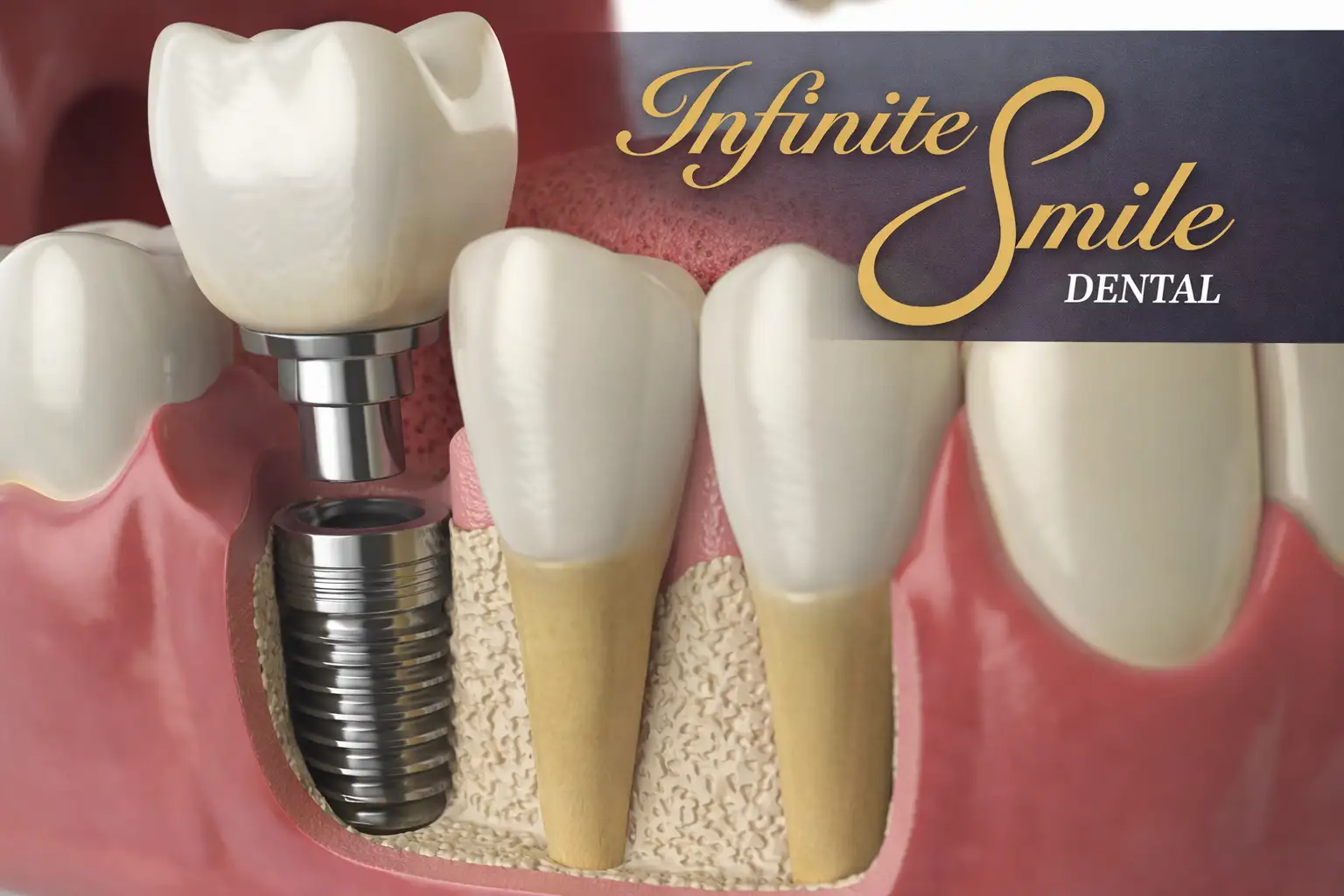 The Ultimate Guide to Dental Implants in Pleasanton, CA