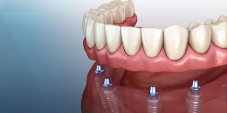 Implant-Supported Dentures in Pleasanton, CA