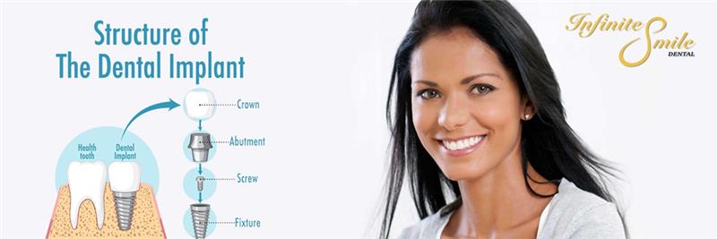 Transform Your Smile with Personalized Dental Implants