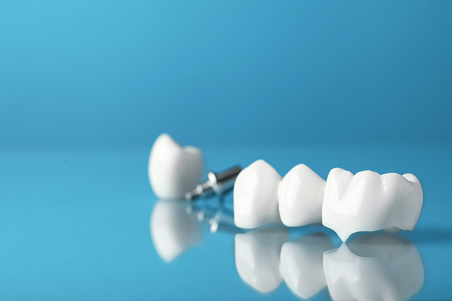 Restoring Your Smile with Crowns and Bridges in Pleasanton, CA