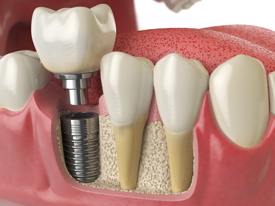 The Ultimate Guide to Dental Implants in Pleasanton, CA