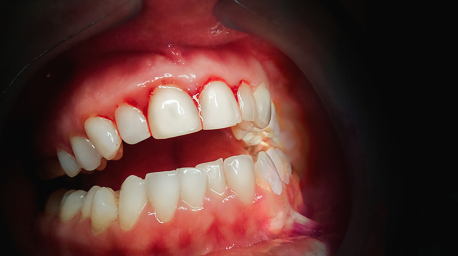 Understanding and Treating Gum Disease in Pleasanton, CA