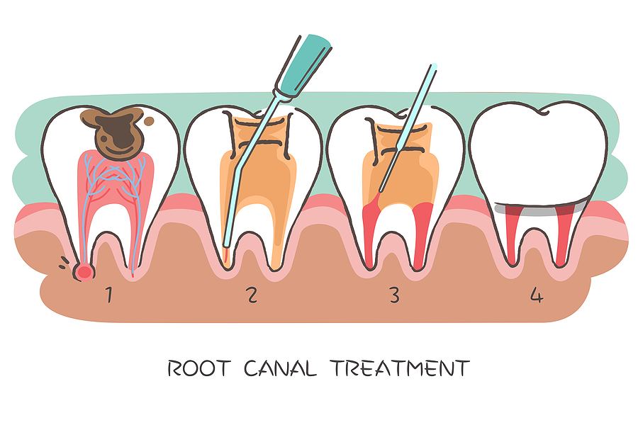 Everything You Need to Know About Root Canals in Pleasanton, CA
