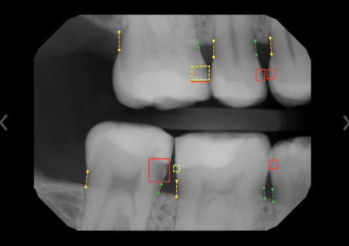 Example of AI-assisted analysis of a digital X-ray